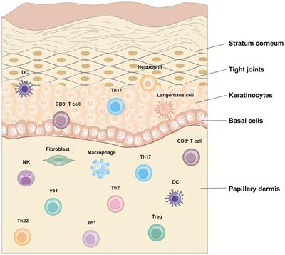 Immune cells in the epithelial immune microenvironment of psoriasis: emerging therapeutic targets